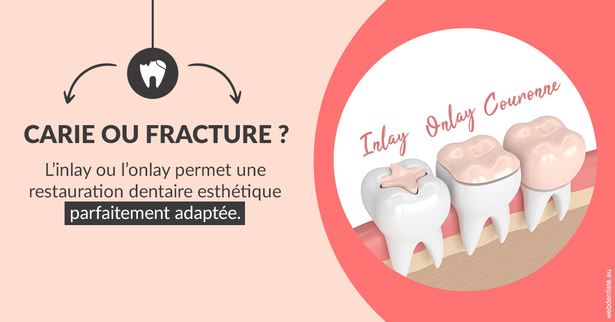 https://dr-fortier-pierre.chirurgiens-dentistes.fr/T2 2023 - Carie ou fracture 2