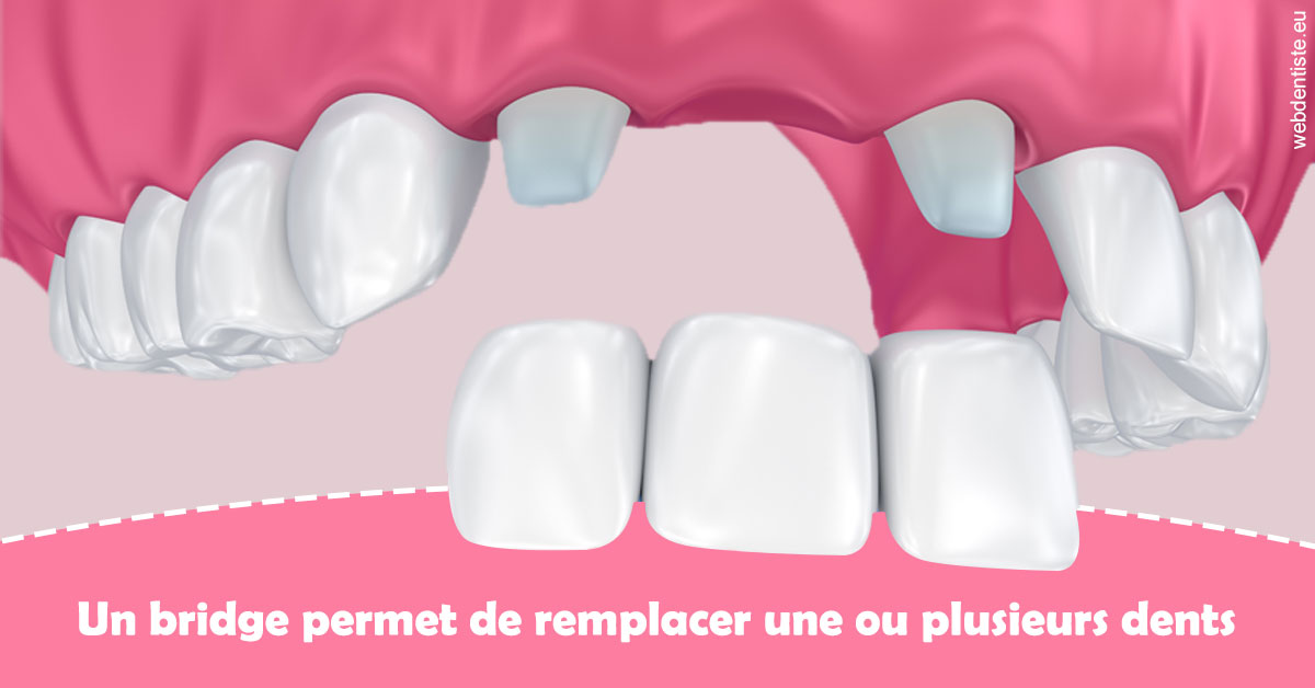 https://dr-fortier-pierre.chirurgiens-dentistes.fr/Bridge remplacer dents 2