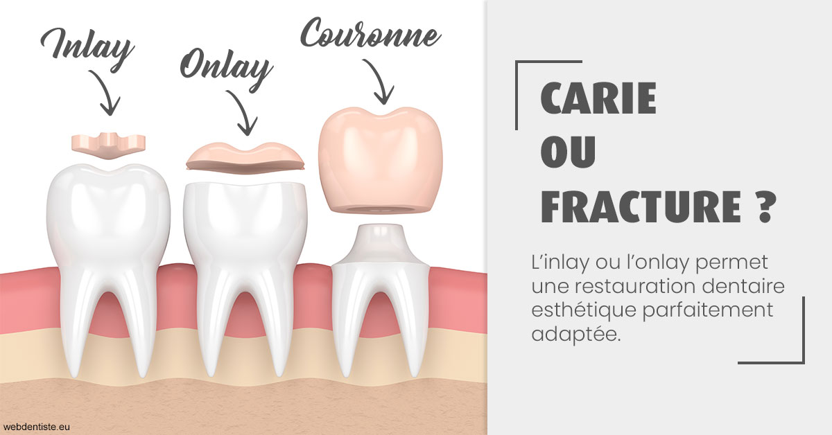 https://dr-fortier-pierre.chirurgiens-dentistes.fr/T2 2023 - Carie ou fracture 1