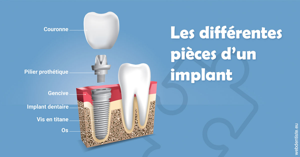 https://dr-fortier-pierre.chirurgiens-dentistes.fr/Les différentes pièces d’un implant 1